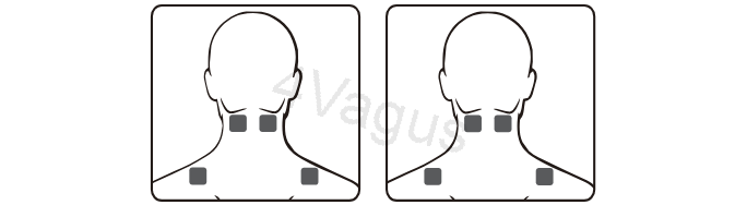 Rozmieszczenie elektrod EMS na szyi