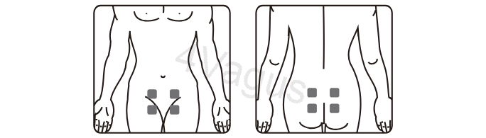 Rozmieszczenie elektrod TENS na brzuchu