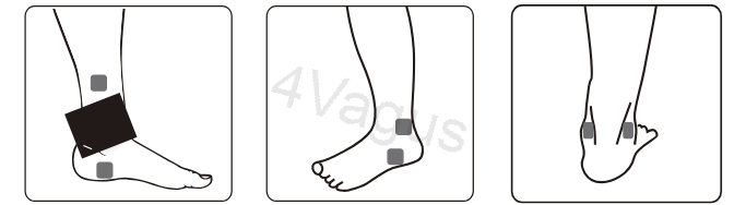 Rozmieszczenie elektrod TENS na stawie skokowym