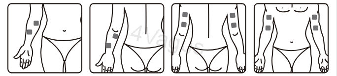 Rozmieszczenie elektrod TENS na ramieniu