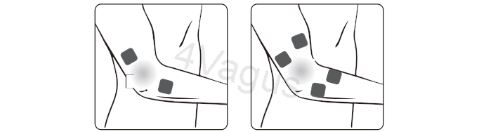 Rozmieszczenie elektrod TENS na stawie łokciowym