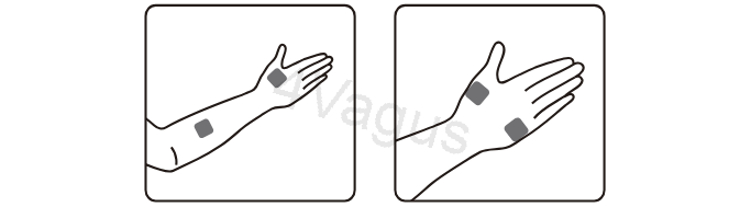 Rozmieszczenie elektrod TENS na dłoni