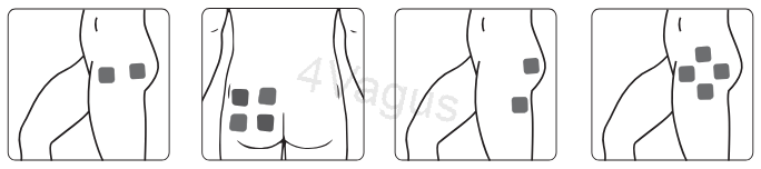 Rozmieszczenie elektrod TENS na biodrze