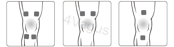 Rozmieszczenie elektrod TENS na stawie kolanowym