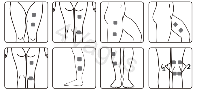 Rozmieszczenie elektrod TENS na nodze (wskazane pozycje 1 i 2)