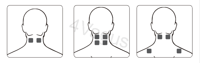 Rozmieszczenie elektrod TENS na szyi